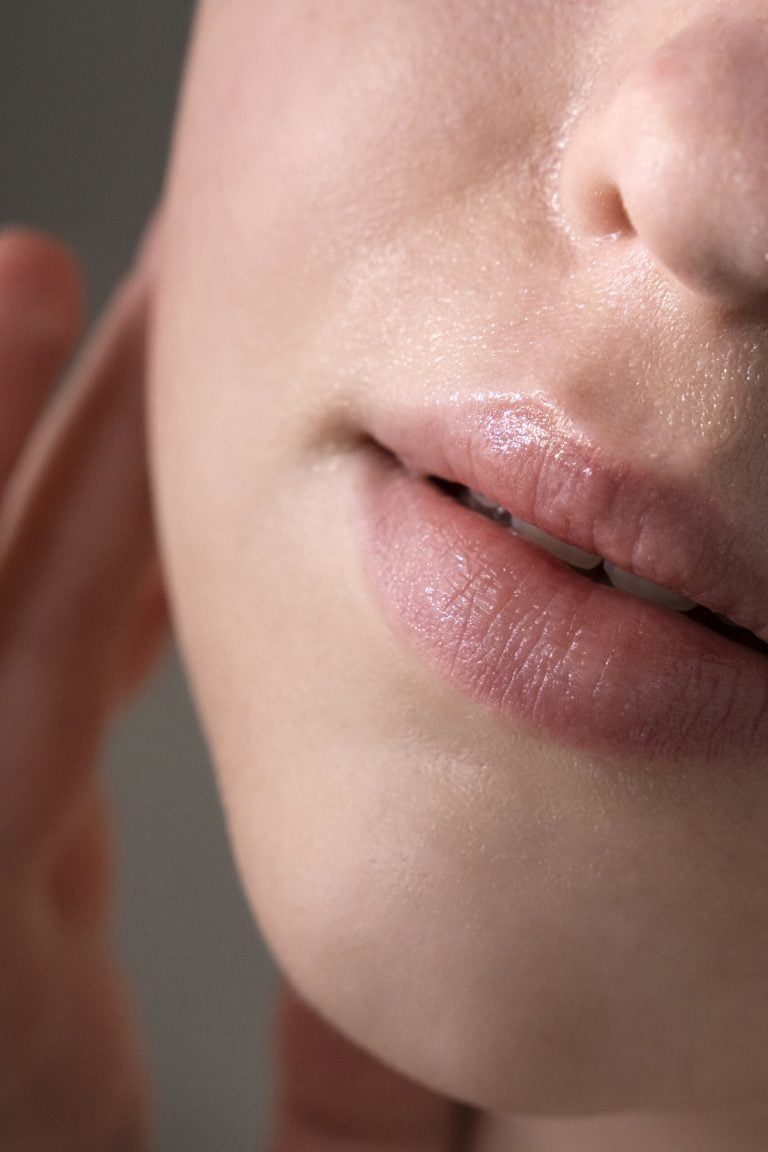 Bruising After Lip Filler What To Expect And How To Minimise Discomfort