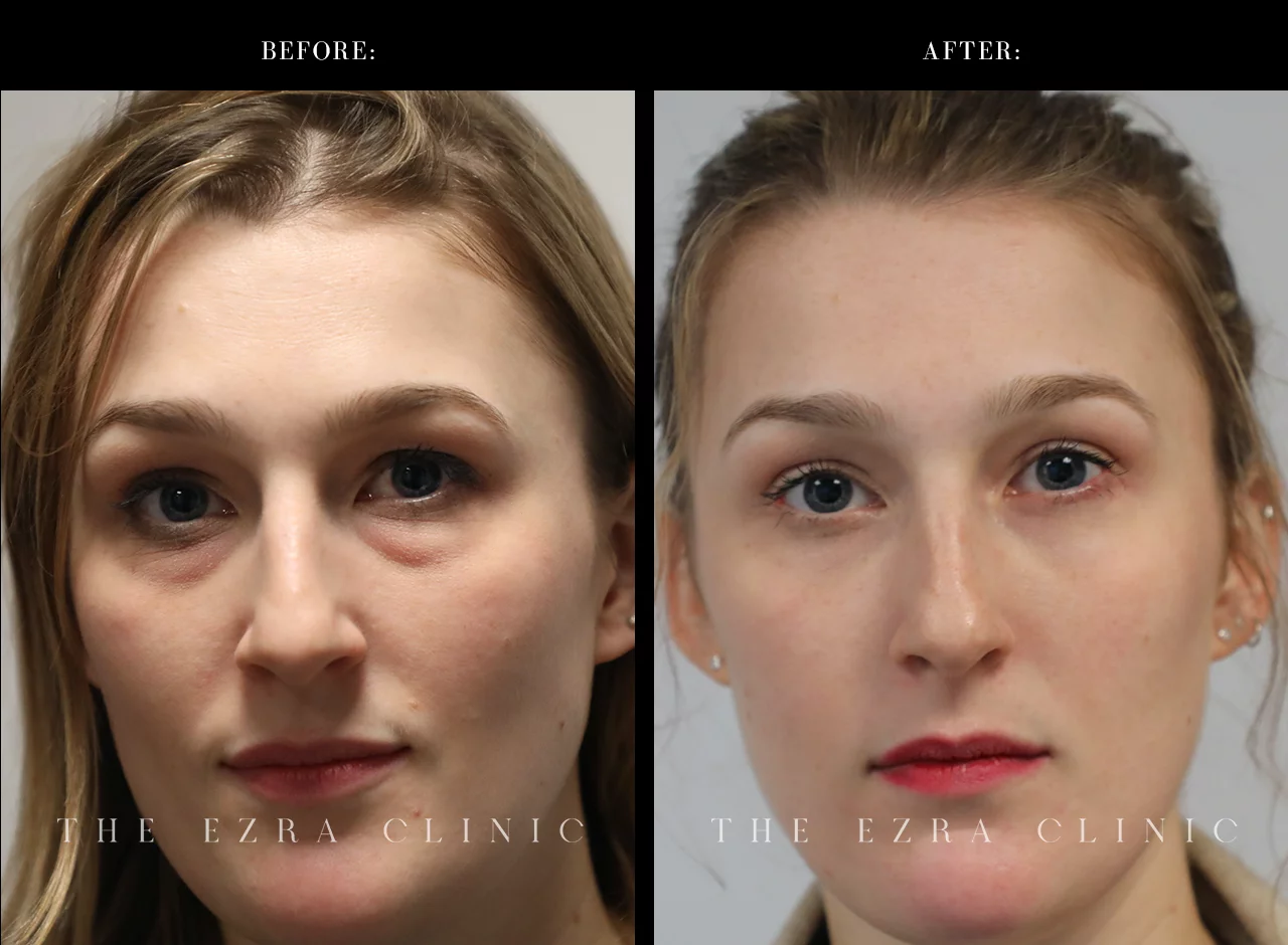 blepharoplasty before and after woman