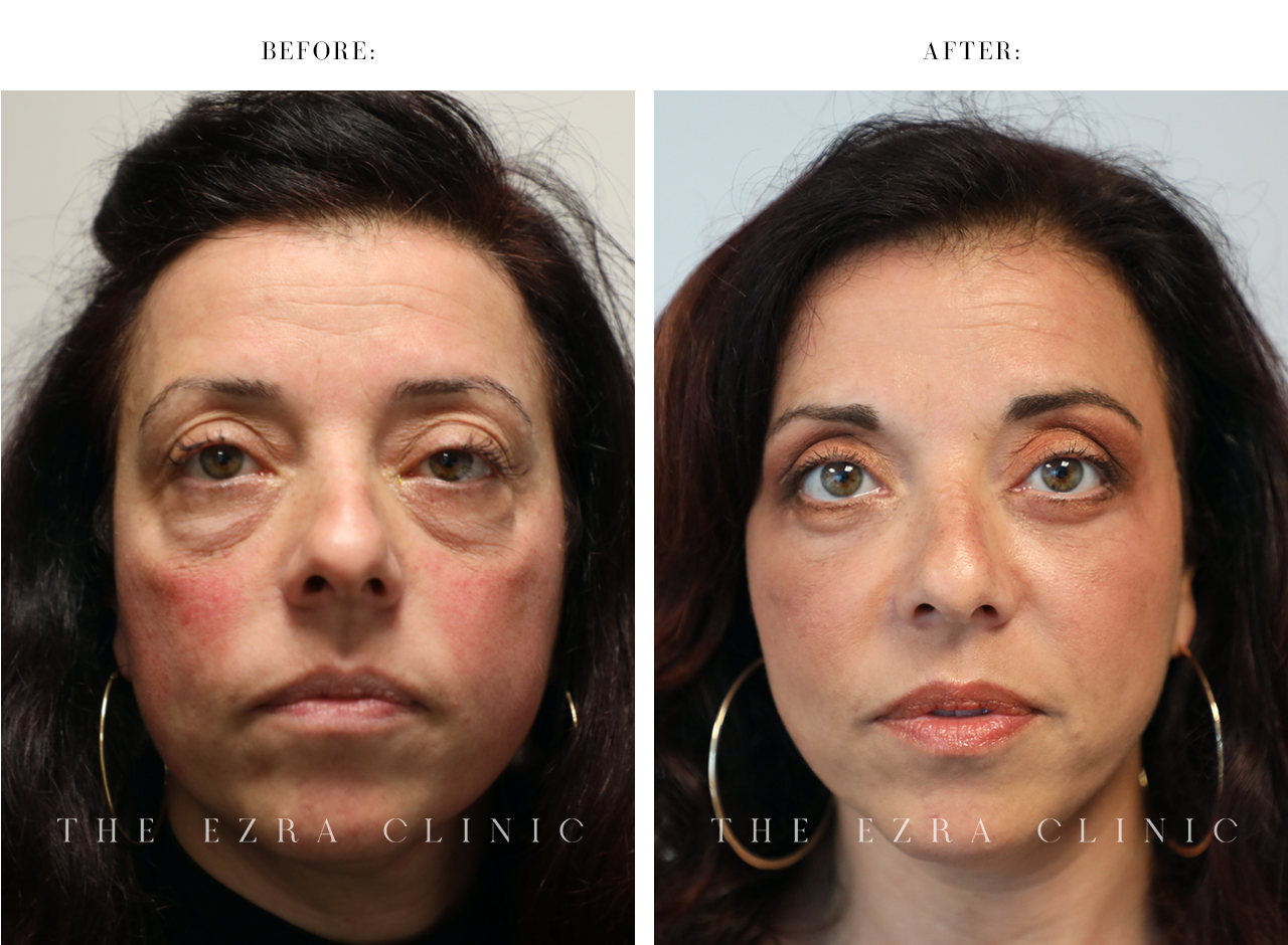 Before and After Eyelid Treatment by a UK Eyelid Surgeon  Daniel Ezra