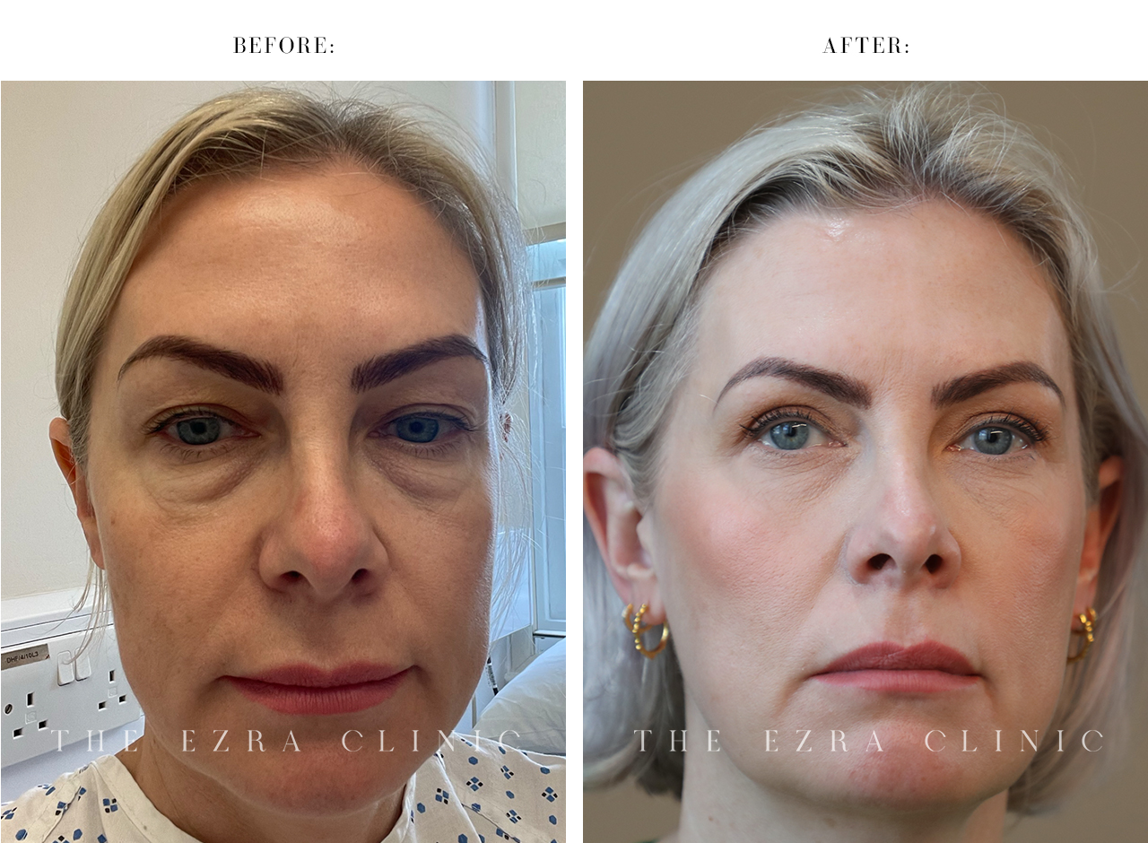 Before and After Eyelid Treatment by a UK Eyelid Surgeon