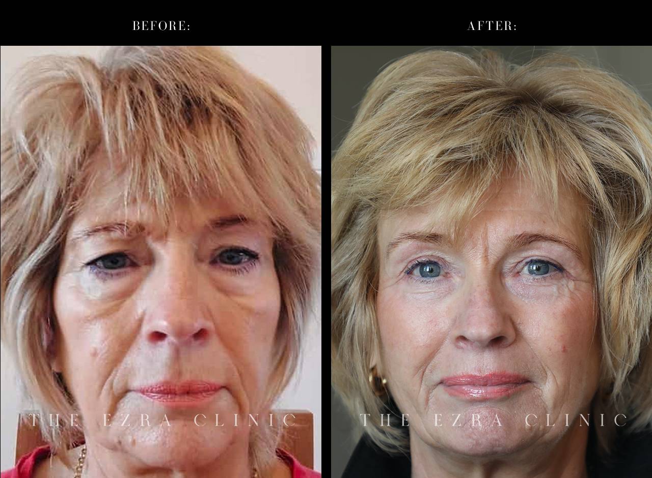 eyelid surgery before and after man