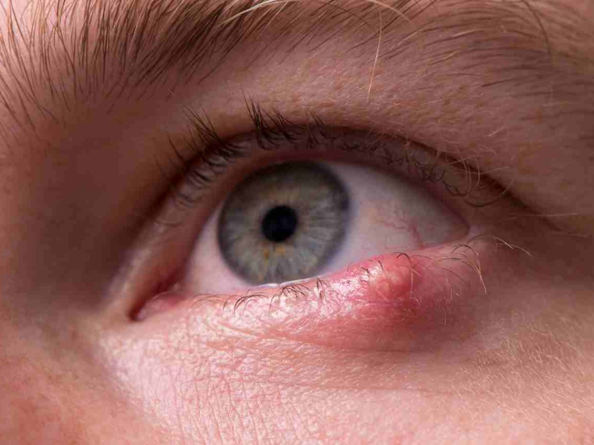 White bump on eyelid for months online